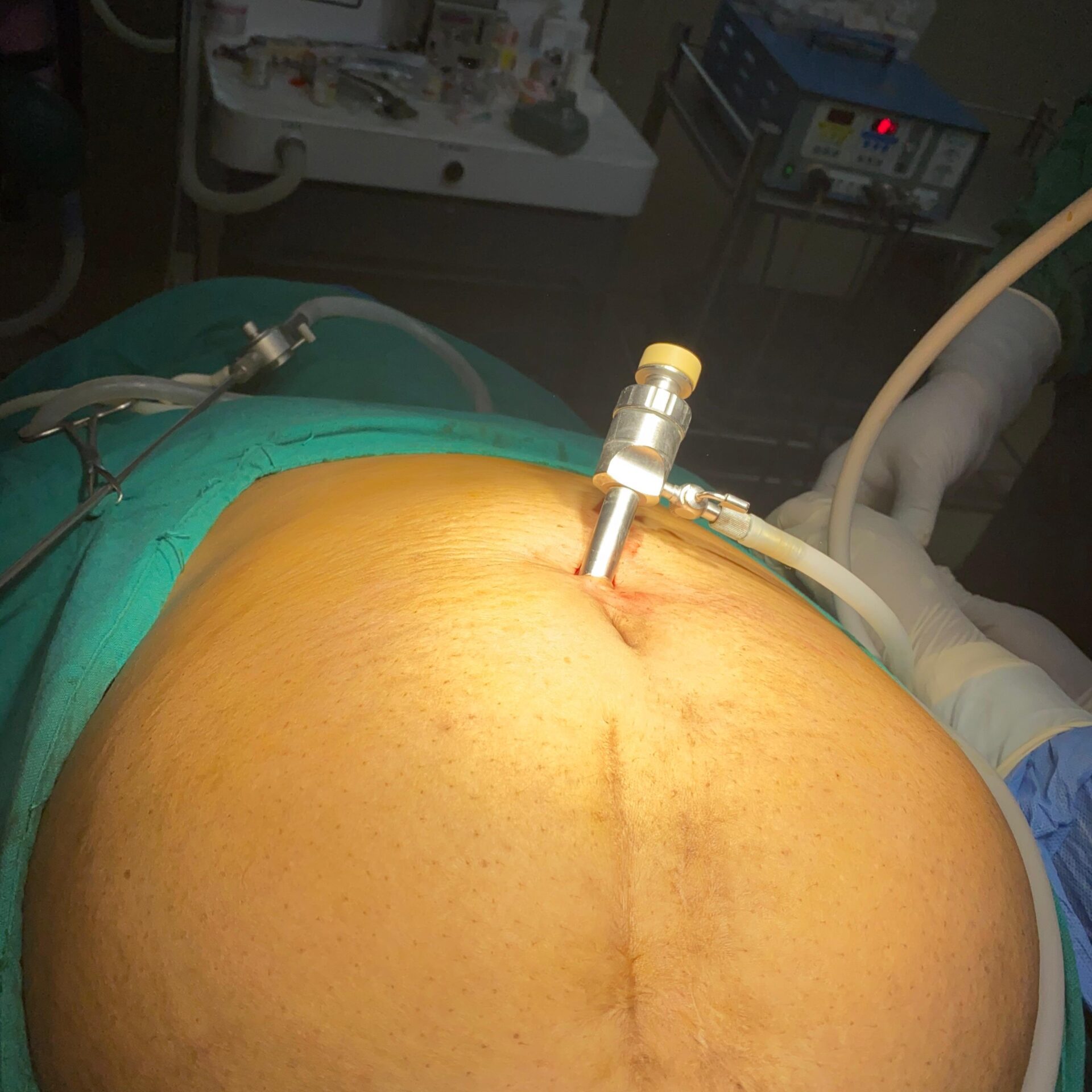 laproscopy